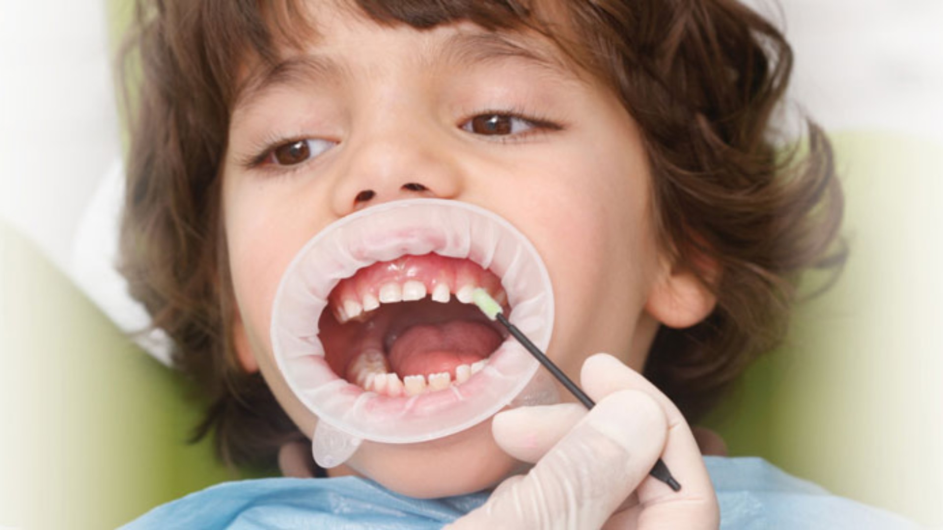 Preventive Dental Treatment for Children in Karad