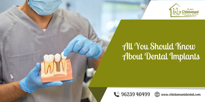 All You Should Know About Dental Implants